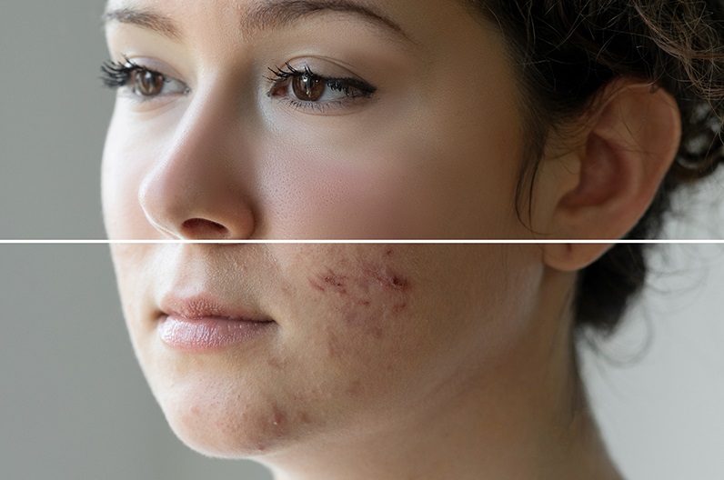Buy Ultima-Accutane Online Is It Safe? Isotretinoin for Skin