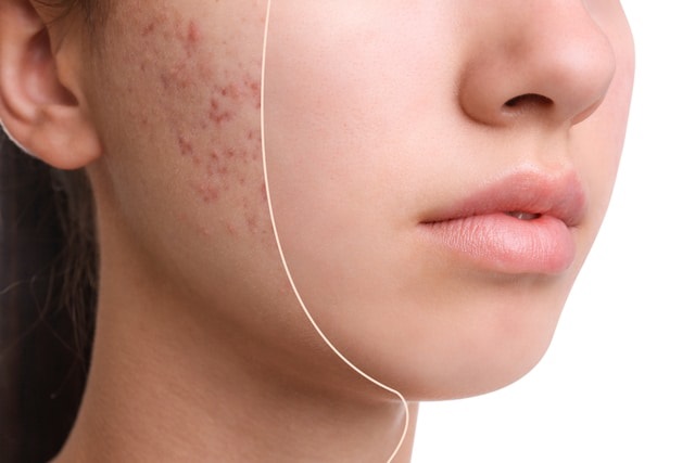 Are You Tired of Severe Acne Buy Ultima-Accutane Online